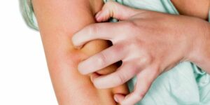 Strona główna 17 mueckenstich juckt